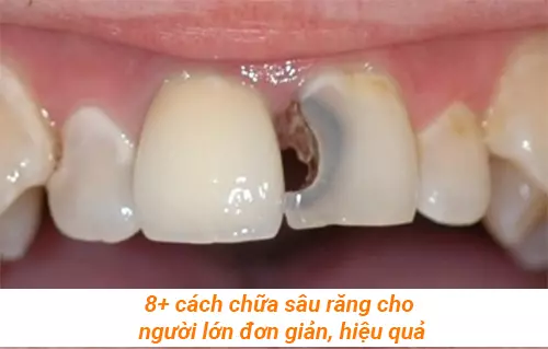 8+ cách chữa sâu răng cho người lớn đơn giản, hiệu quả